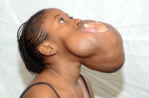 tumor