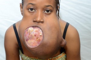 tumor.jpg1