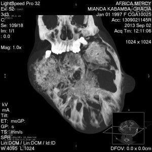 tumor.jpg2