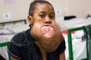 tumor.jpg3