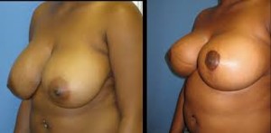 breast