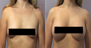 Breast