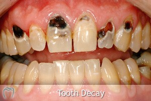 tooth decay